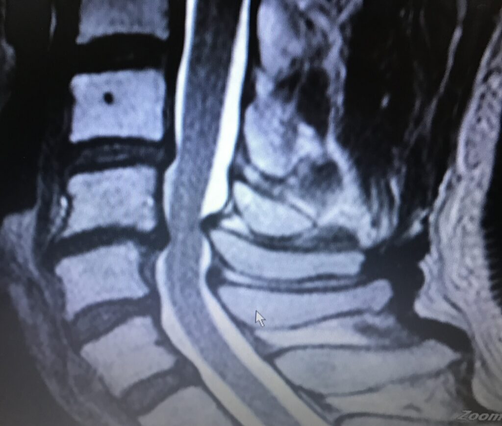 むち打ちの症状を他覚的所見で立証するMRI T2強調画像。府中でむち打ちなら弁護士法人あさかぜ法律事務所に無料相談